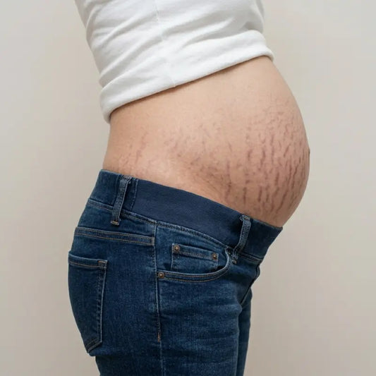 Ces vergetures qui apparaissent pendant la grossesse : pourquoi, et surtout quoi faire