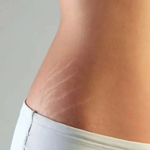 Cicatrice de césarienne atténuée avec silicone médical EFFAZE