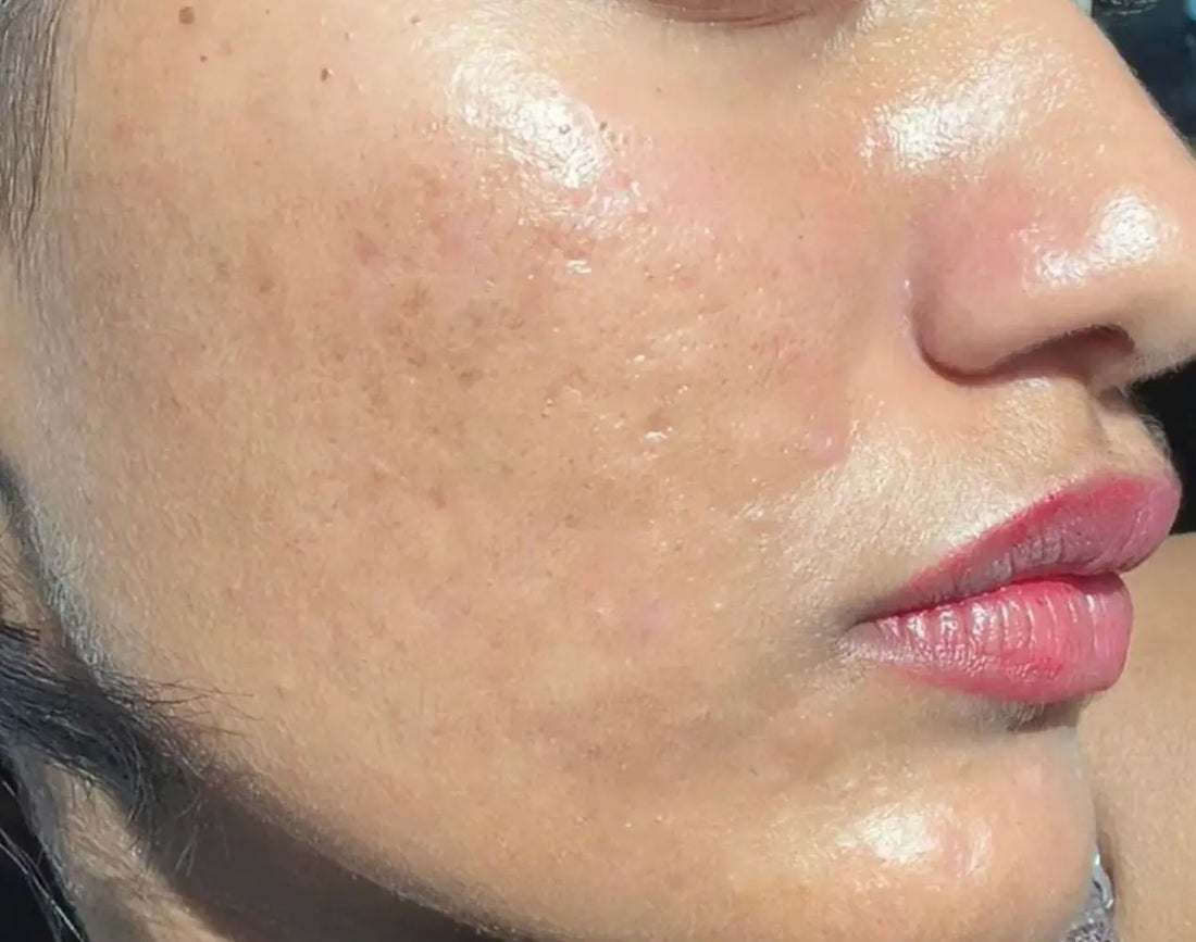 Atténuer cicatrices post-acné avec silicone médical EFFAZE