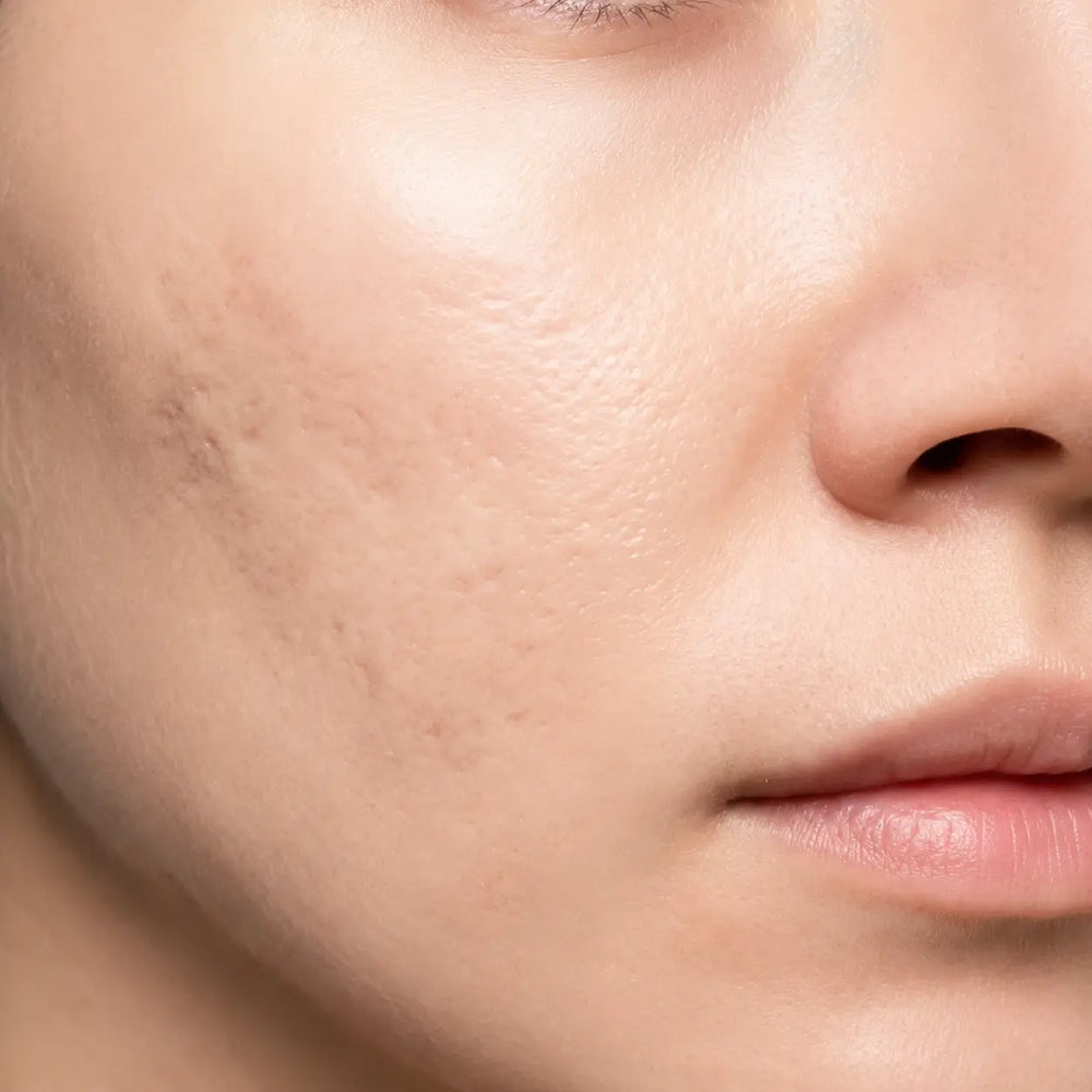 Gros plan sur la même zone du visage après plusieurs semaines d'application du stick EFFAZE, texture visiblement lissée