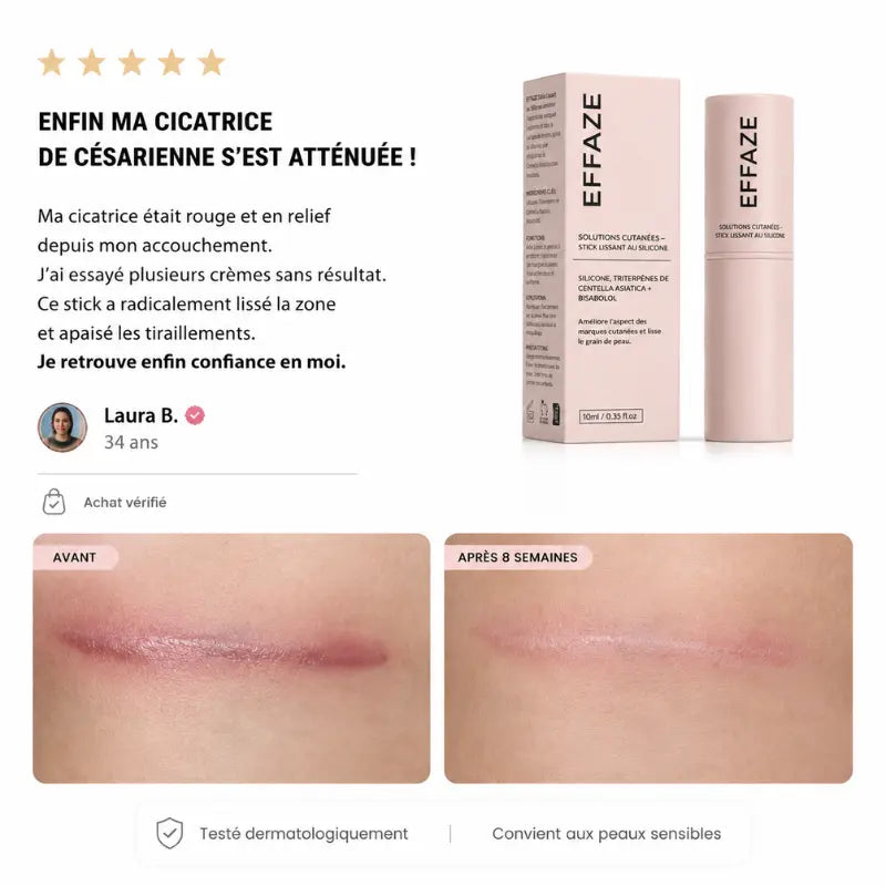 Avis vérifié avant après cicatrice césarienne atténuée 8 semaines stick EFFAZE silicone médical testé dermatologiquement peaux sensibles