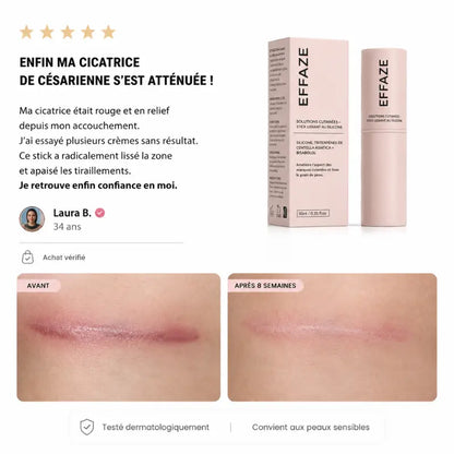 Avis vérifié avant après cicatrice césarienne atténuée 8 semaines stick EFFAZE silicone médical testé dermatologiquement peaux sensibles