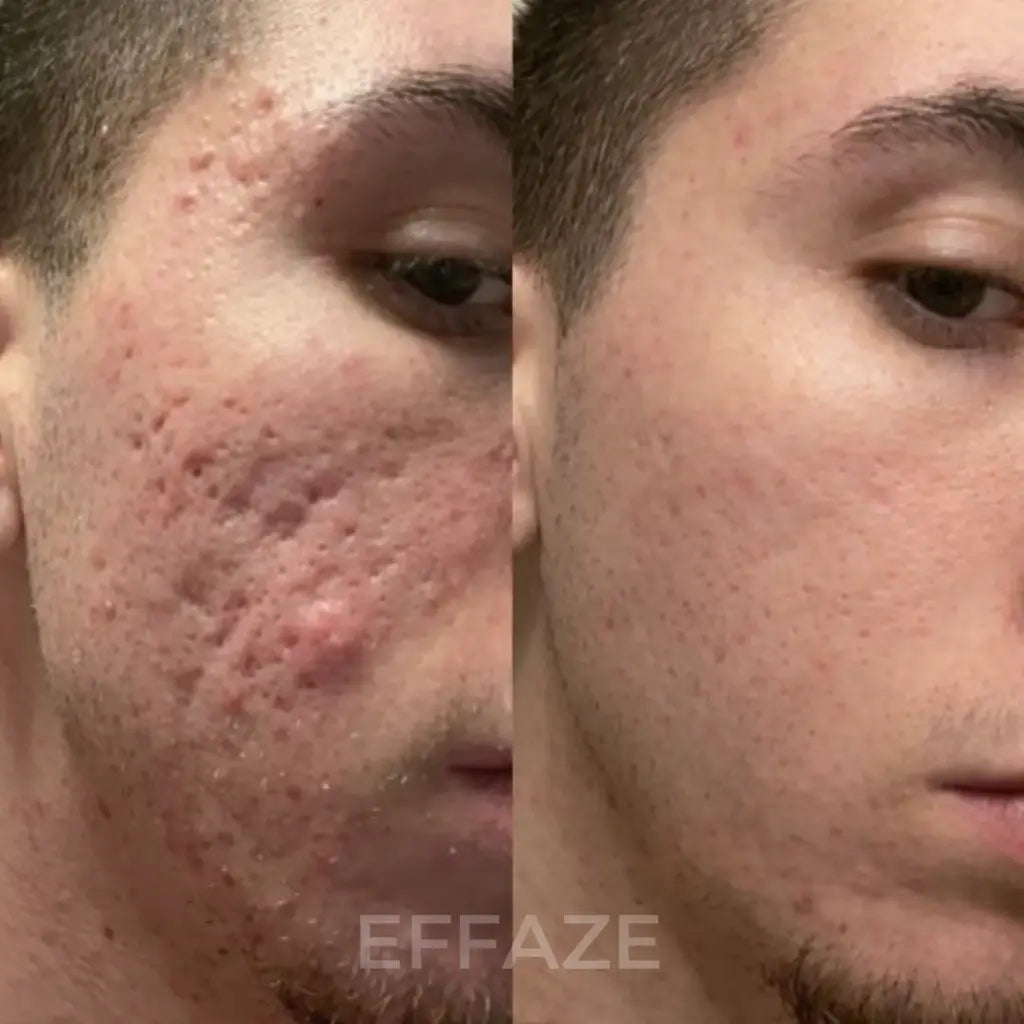 Avant après traitement cicatrices acné visage homme avec le stick silicone médical Effaze résultats visibles sur texture et lissage peau
