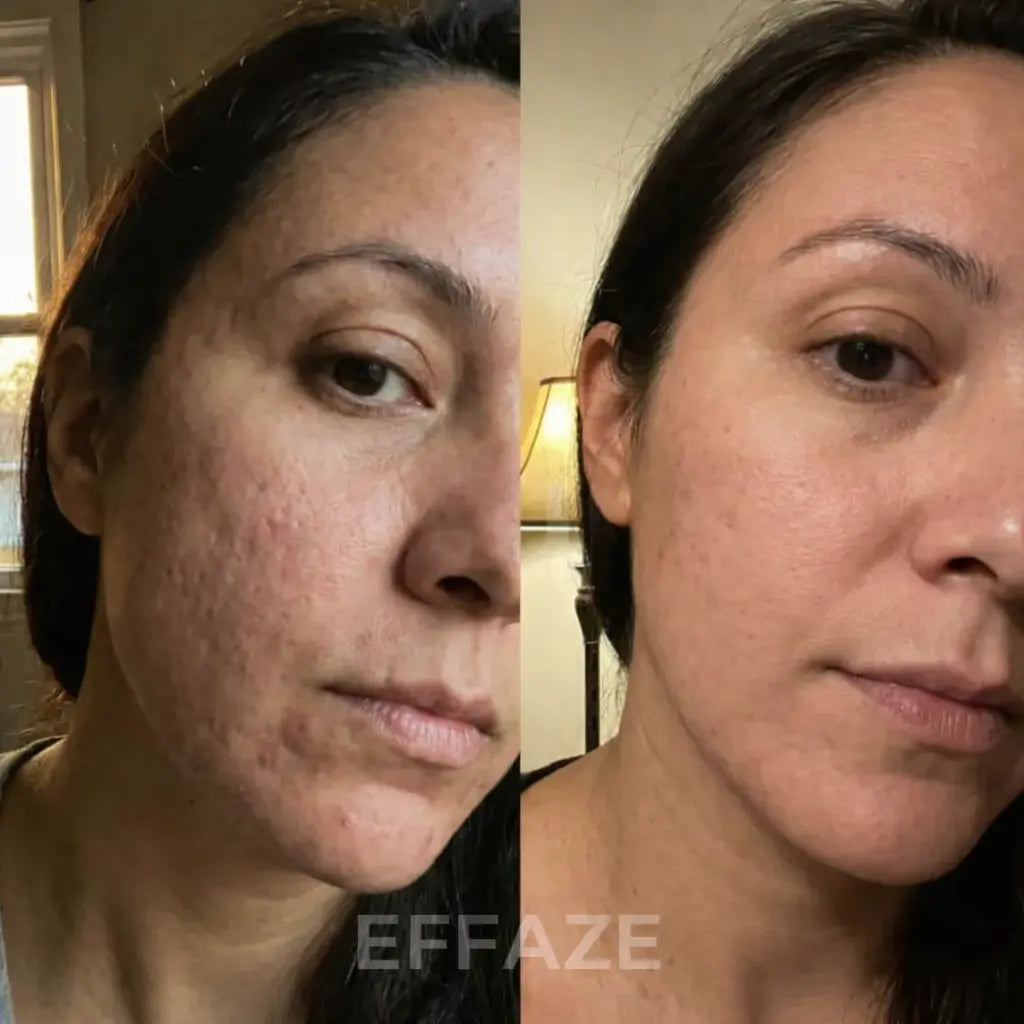 Photo avant après amélioration visible du grain de peau avec le stick EFFAZE – lissage des cicatrices d'acné et réduction des marques cutanées sur le visage, résultat client réel