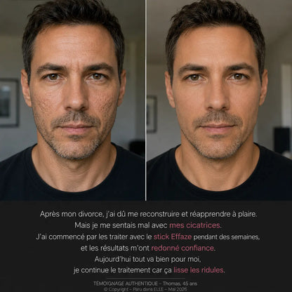 Témoignage client homme - avant après cicatrices acné avec le stick EFFAZE